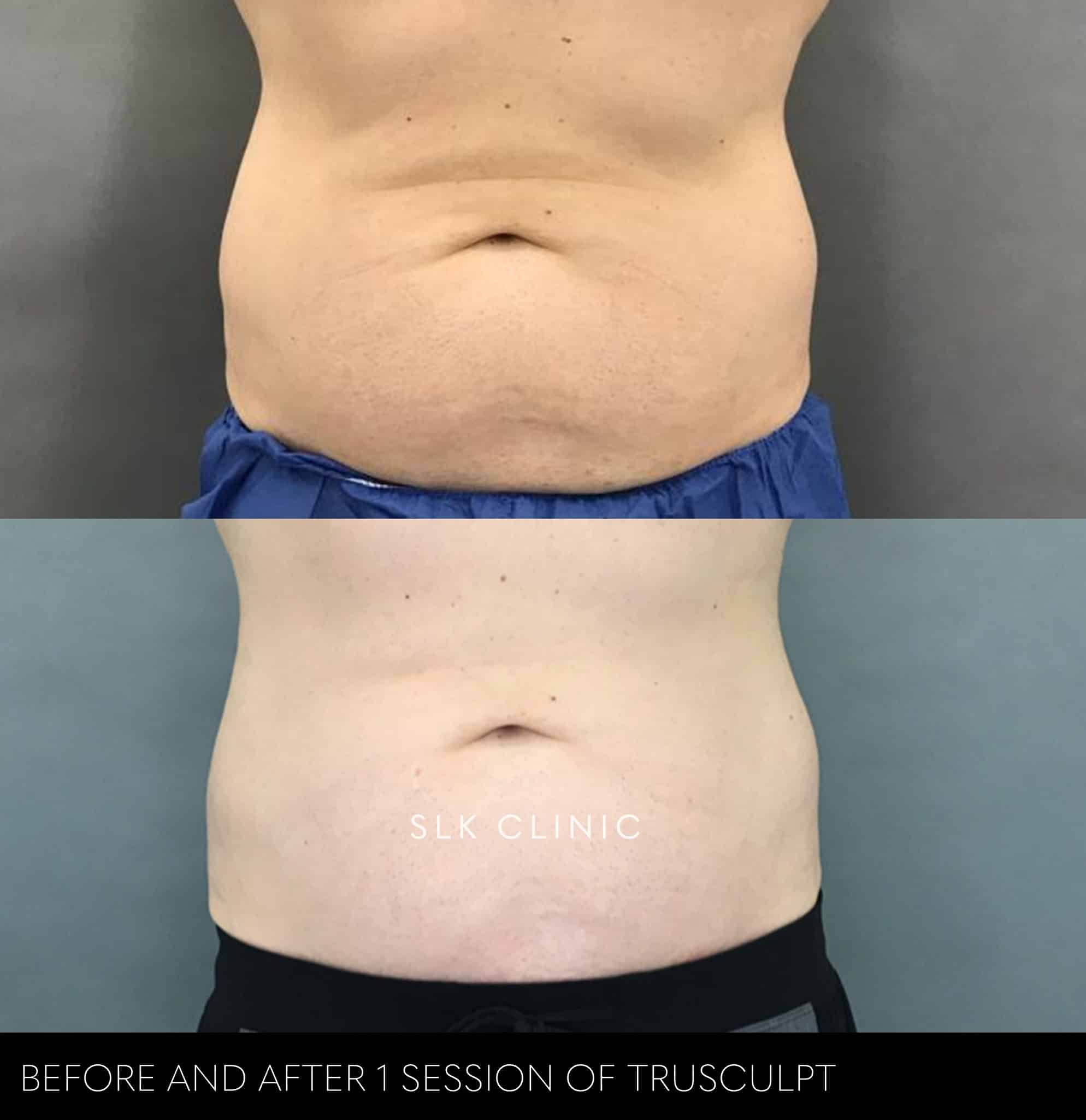 truSculpt iD · abdomen