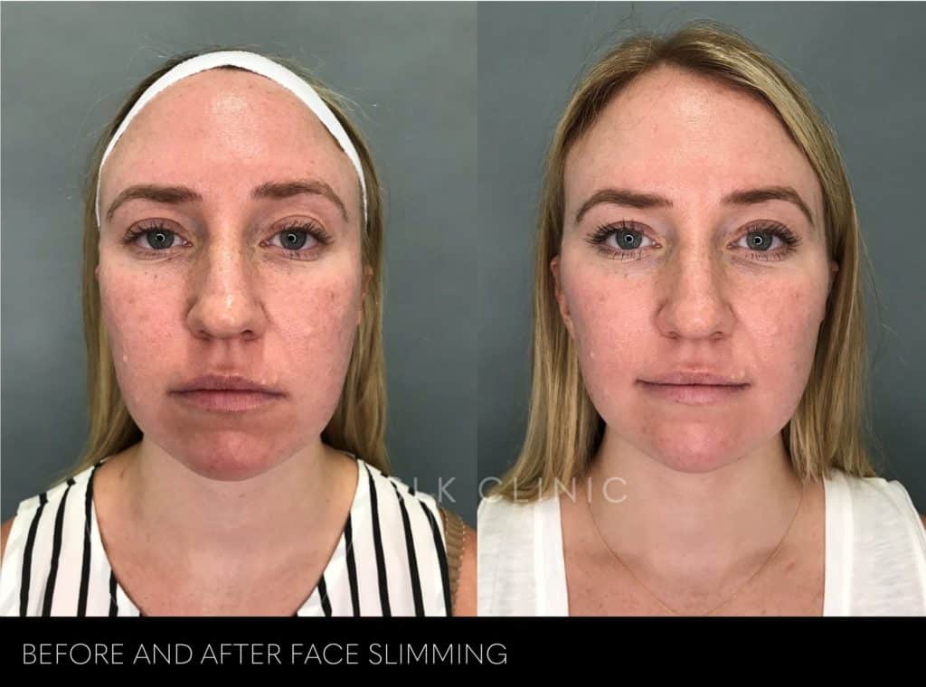 Woman gets treated with face slimming and cheek filler