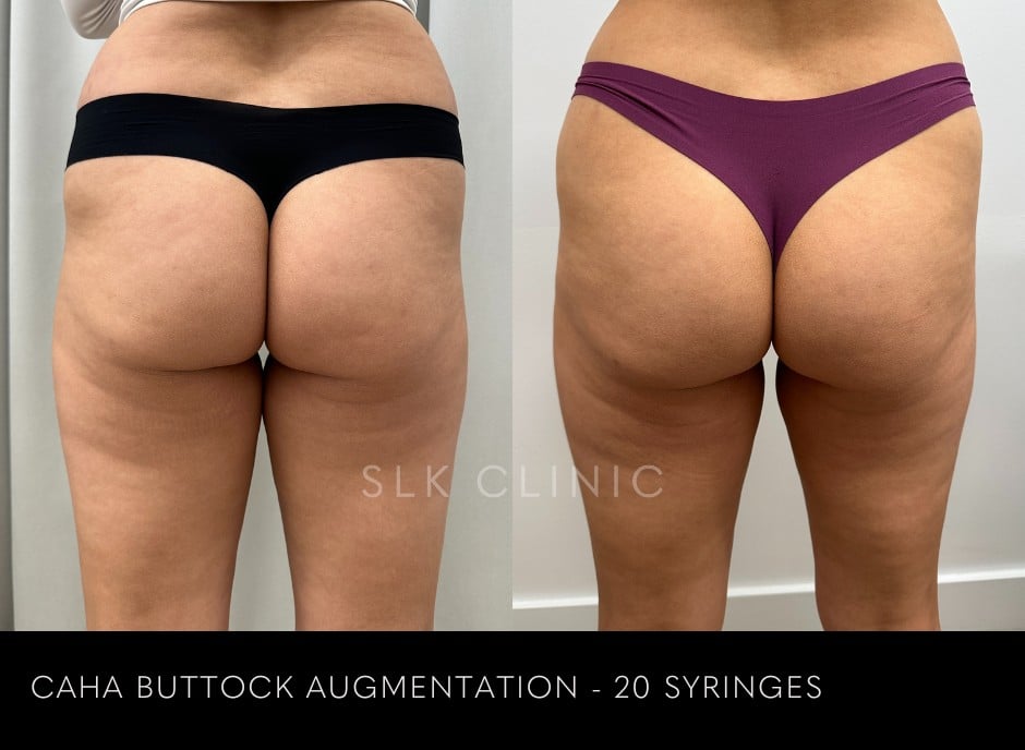 Caha-buttock-augmentation-nonsurgical-bbl-20-syringes-radiesse-caha-07.2024.jpg