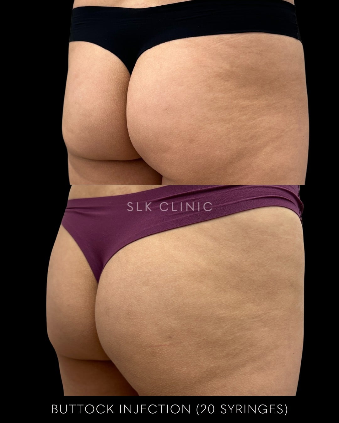 before-and-2-months-after-CaHa-sculptra-buttock-augmentation-nonsurgical-BBL-20-syringes-07.2024.jpg