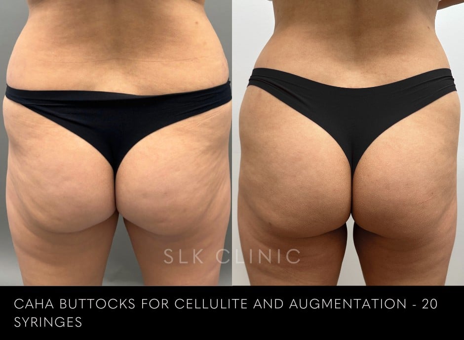 before-and-2-months-after-caha-buttock-augmentation-with-improvement-in-cellulite-dimples-07.04.2024.jpg