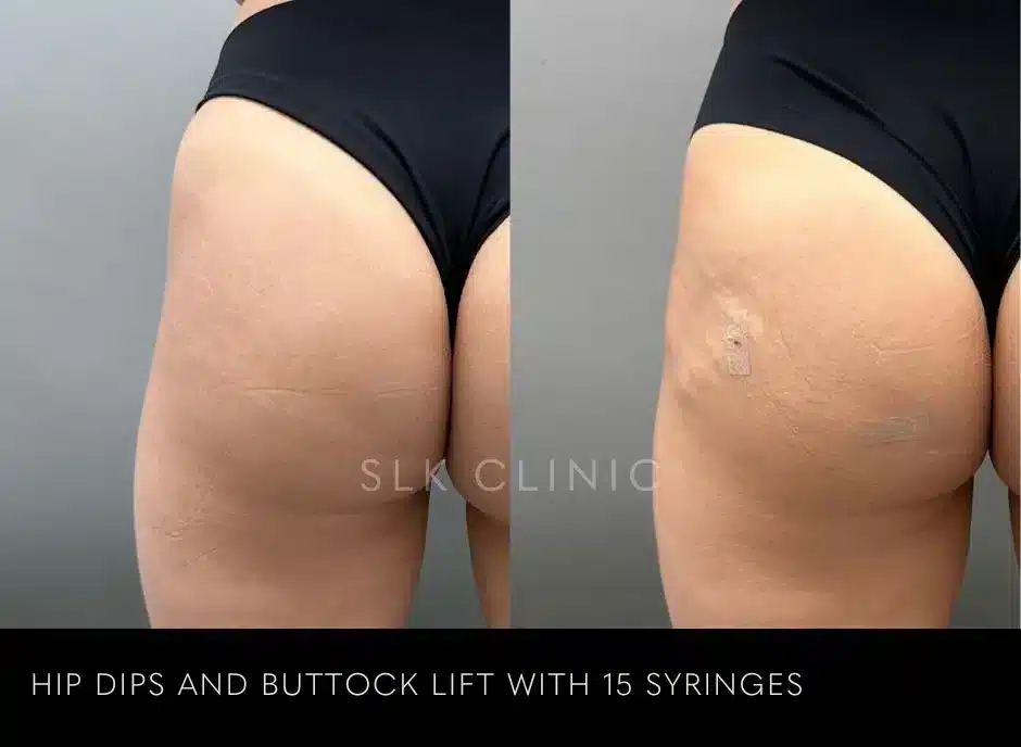 buttock-injection-augmentation-bbl-butt-lift-chattanooga-2-jpg.webp