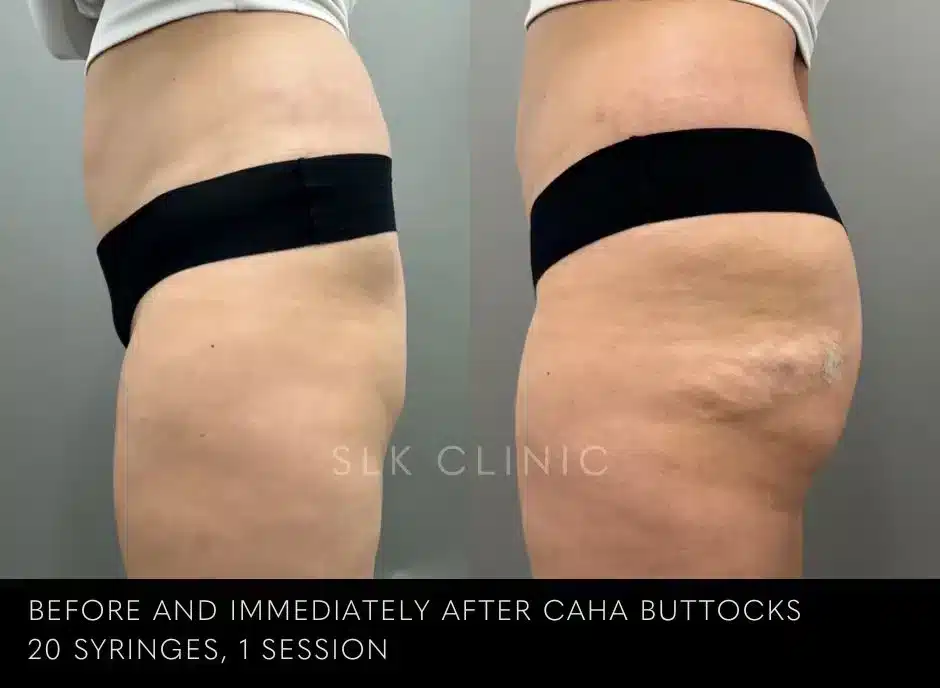 buttock-injection-augmentation-bbl-butt-lift-chattanooga-jpg.webp
