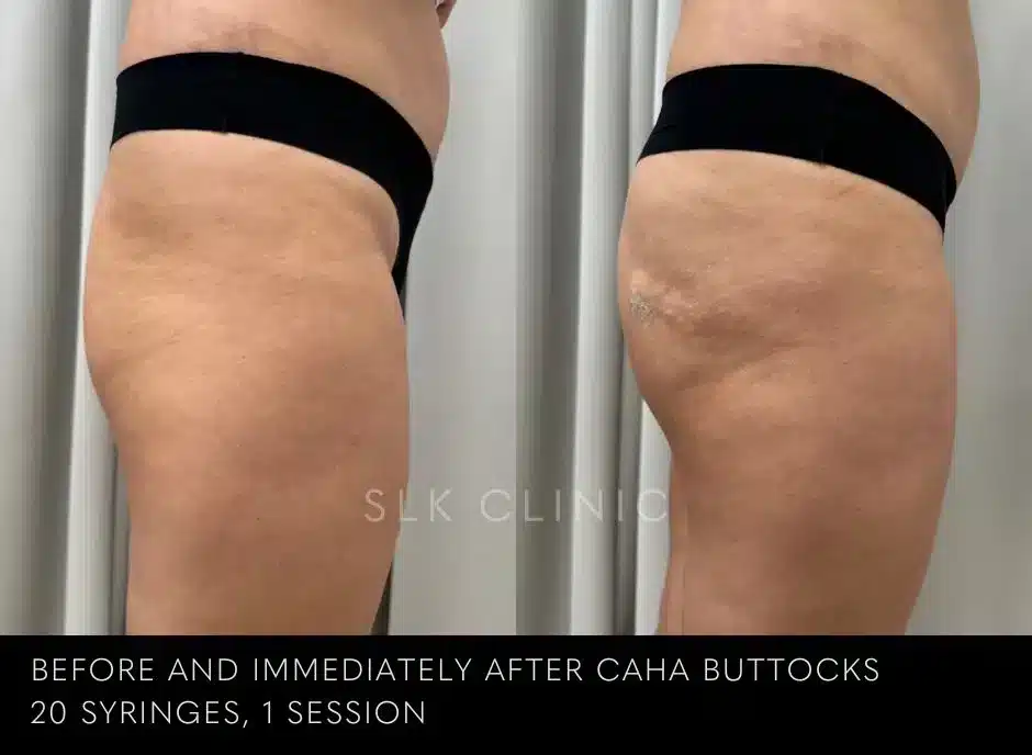 buttock-injection-augmentation-bbl-butt-lift-nashville-before-after-results-2-jpg.webp