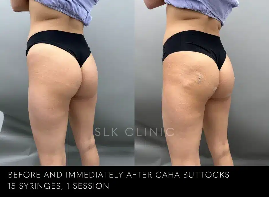 buttock-injection-augmentation-bbl-butt-lift-nashville-before-after-results-3-jpg.webp