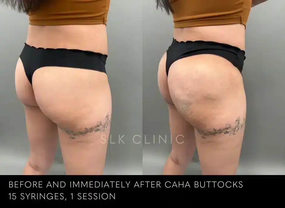 buttock-injection-augmentation-bbl-butt-lift-nashville-before-after-results-jpg.webp