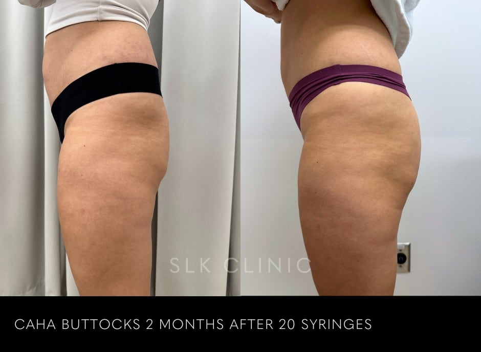 good-before-and-after-result-of-CAHA-Buttocks-non-surgical-bbl-after-2-months-20-syringes-and-skincare-regimen-07.04.2024.jpg
