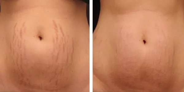 before and after photo of stretch mark removal results